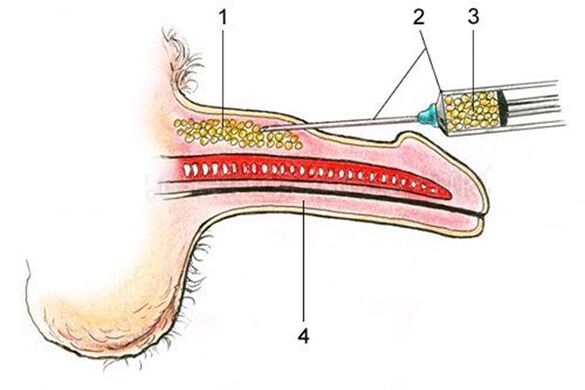Lipofilling das Einbringen von Fettgewebe in den Penisschaft
