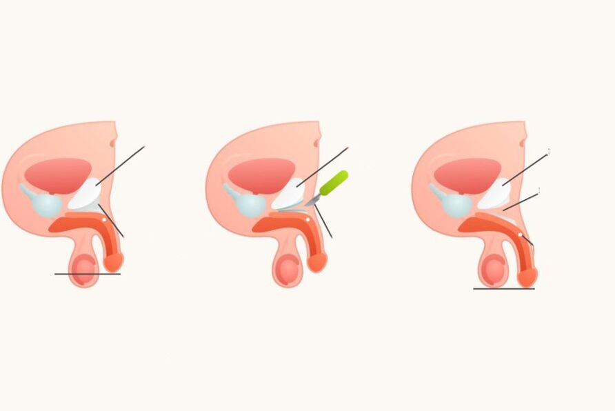 LigationTomie, um den Penis zu erhöhen