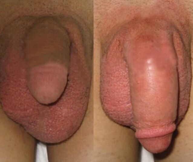 Das Ergebnis der Installation einer Kollagenmatrix im Penis