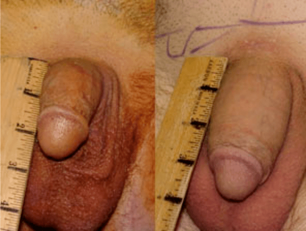 Vor und nach Lipofilling und Gelimplantation