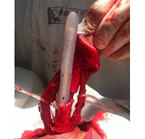Muskelgewebetransplantation zur Vergrößerung des Penis