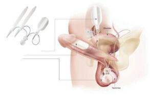 Einsetzen von Implantaten in den Penis